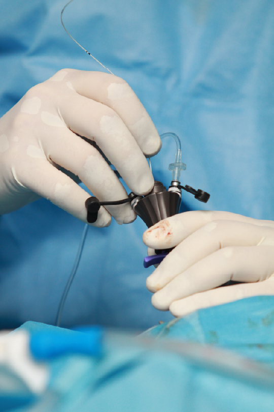 Cirugía laparoscópica